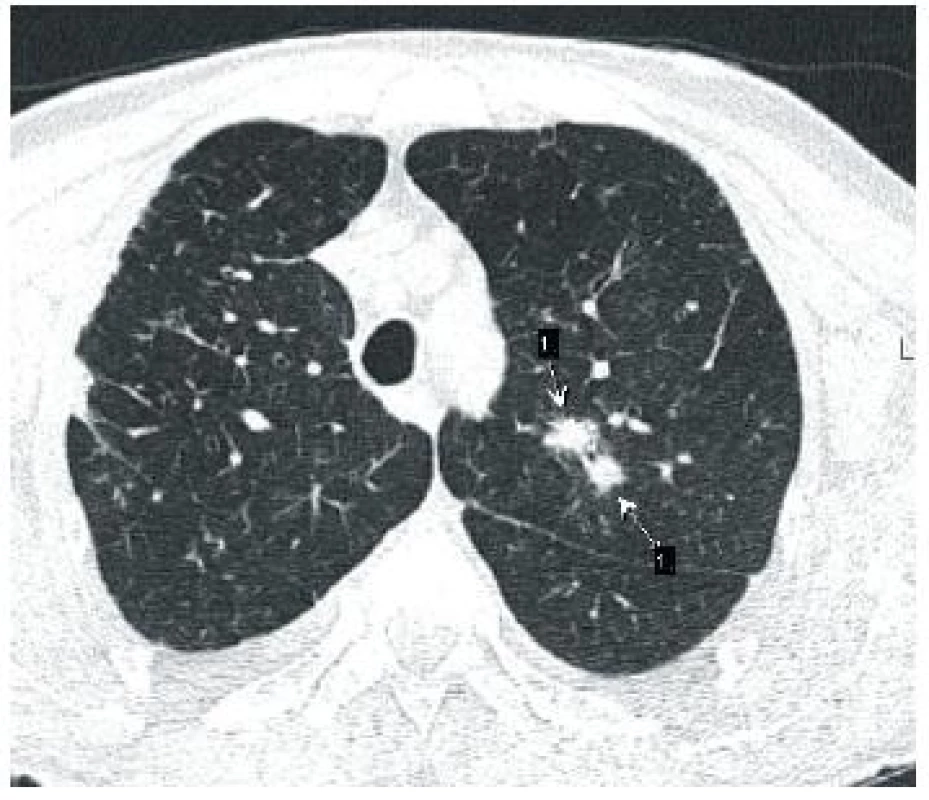 Aspegilóza,hematologické onemocnění, pozitivní galaktoman, febrilní stav