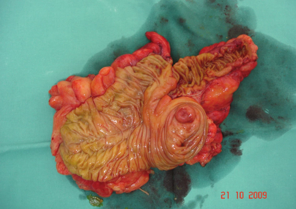 Rozstřižený preparát terminálního ilea, céka, c. ascendens a části c. transverzum
Fig. 7. Section of the preparation of the terminal ileum, caecum, ascending colon and a part of the transverse colon