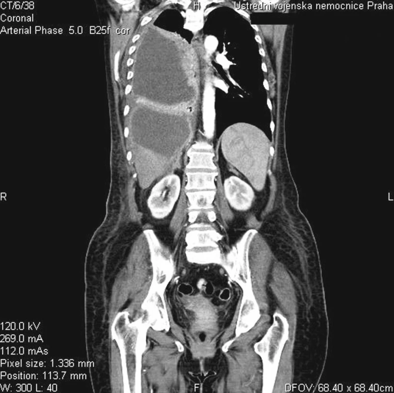 Tekutinové kolekce v okolí jater a v pohrudniční dutině (CT)
Fig. 2. Fluid collections around liver and within the pleural cavity (CT)