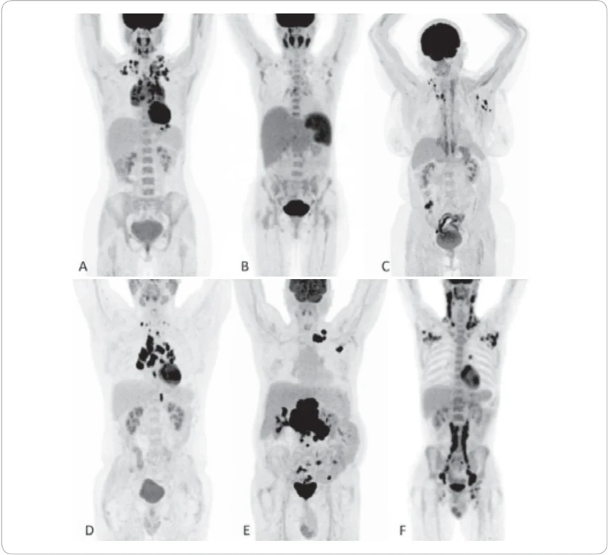  FDG-PET/CT MIP obrazy několika pacientů vyšetřených pro lymfadenopatii a systémové příznaky.