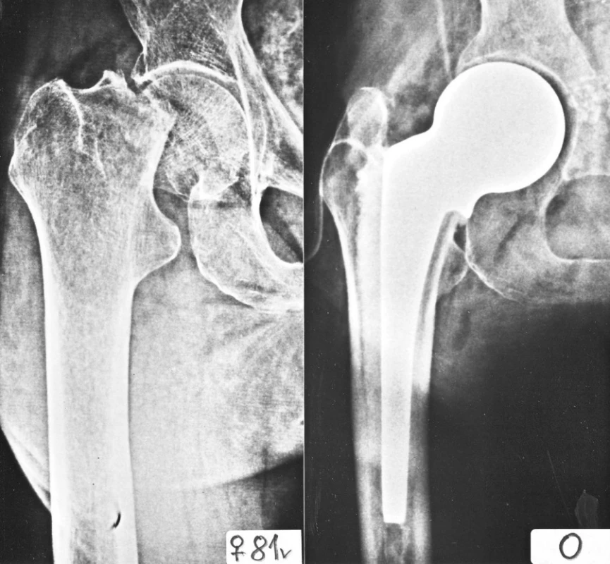 Nový typ cervikokapitální náhrady (Beznoska). A – pacientka, 81 roků. B – stav po operaci. Dobře patrná větší lateralizace dříku, optimální sklon límce z hlediska resekce, rovný tvar dříku
Fig. 7. New type of hip hemiarthroplasty. A – patient, age 81 years, B – after surgery