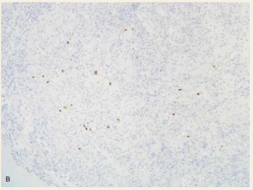 Histologické vyšetření bioptických vzorků odebraných z okrajů vředu v době první koloskopie v intrahemoragické fázi.