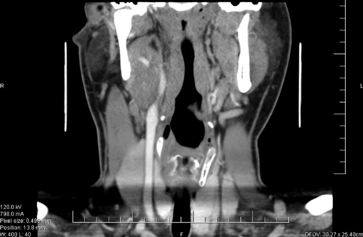 CT dokumentace resistence v oblasti větvení ACC l. dx.
Fig. 1. CT view of the neoplasm in regional branch out of ACC. l.dx.