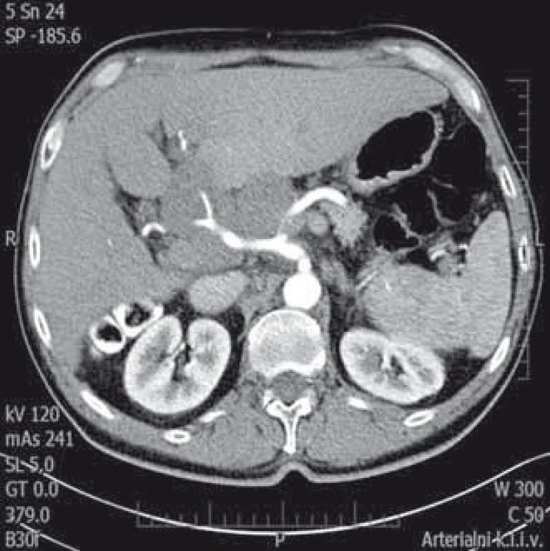 Postižení uzlin jaterního hilu lymfomem. CT vyšetření (arteriální fáze) zachycující paket uzlin v jaterním hilu velikosti 10 × 7 cm. Uzlinami prochází arteria hepatica.
Fig. 3. Lymphoma infiltration of lymph nodes in liver hilum. CT scan (arterial phase) showing bulk lymph nodes in the liver hilum of 10 × 7 cm. Hepatic artery incasement.