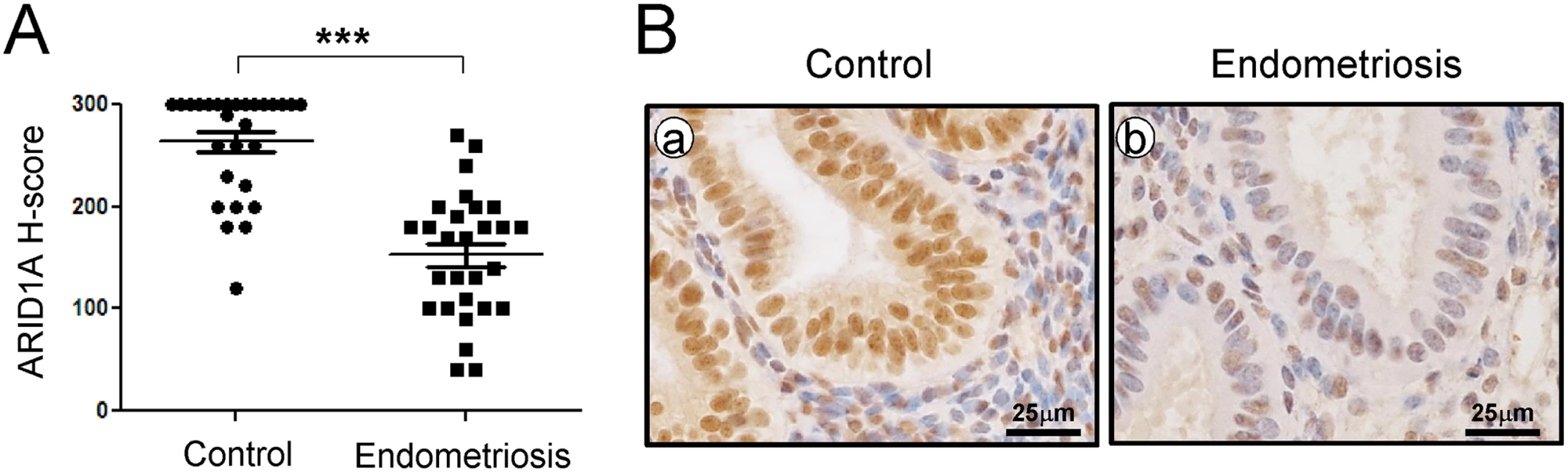 ARID1A loss in eutopic endometrial tissue from infertile women with endometriosis.