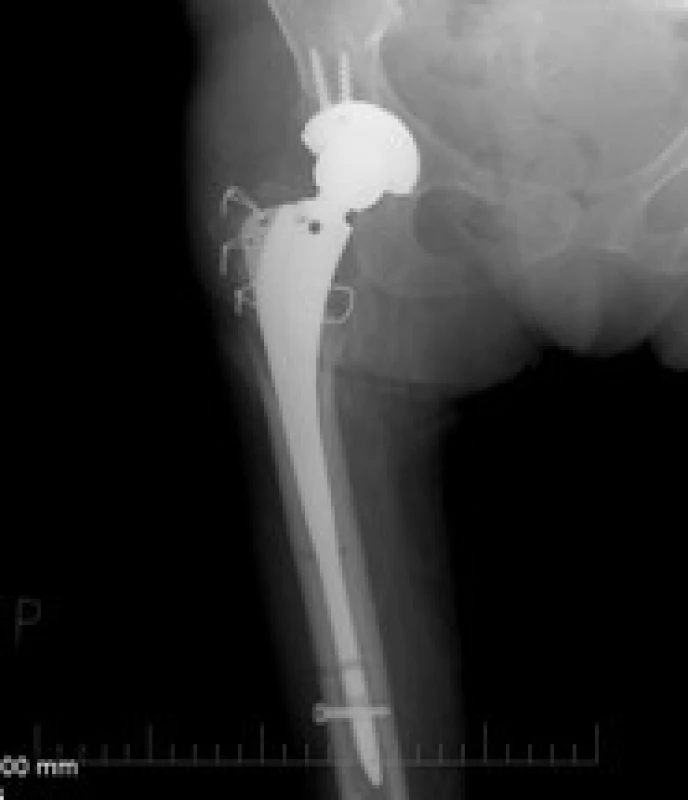 Za 10 dnů provedena implantace TEP