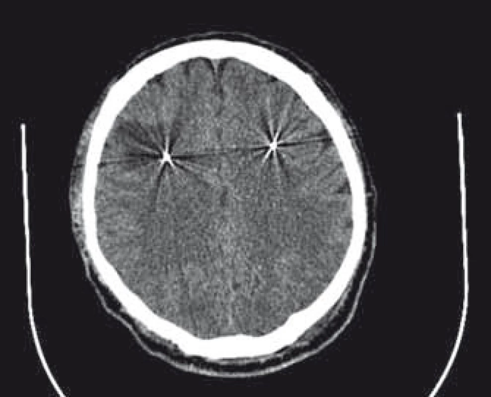 CT vyšetrenie 3. deň po operácii s hypodenzným ložiskom okolo elektródy vpravo.
Fig. 1. CT scan 3 days after operation with hypodense lesion around electrode on the right side.