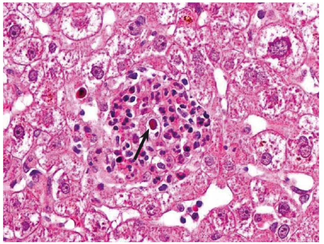 CMV hepatitida. Mikroabsces tvořený shlukem neutrofilů s intranukleární virovou inkluzí (šipka). Hematoxilin-eozin, původní zvětšení 400×.
Fig. 1. CMV hepatitis. Micro-abscess formed by a collection of neutrophils with intranuclear viral inclusion (arrow). Haematoxylin-eosin, original magnification ×400.