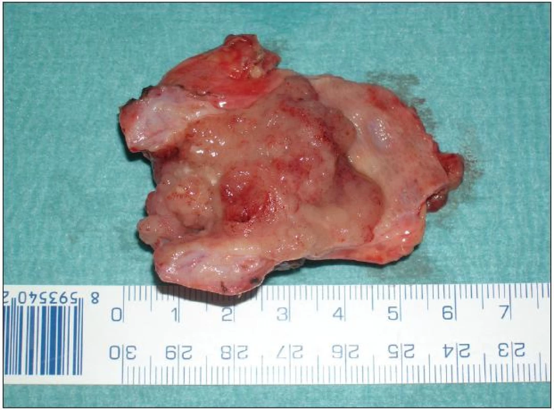Resekát extrahepatálních žlučovodů s papilární formou Klatskinova tumoru typu Bismuth II
Fig. 7: Resection extrahepatic biliary duct for papillary type of Klatskin tumor Bismuth II
