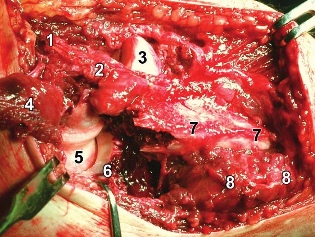 Rozšířený modifikovaný Kocherův přístup – revize proximální ulny: 1 – epicondylus lateralis humeri, 2 – lig. collaterale lat., 3 – hlavice radia, 4 – odklopený m. anconeus, 5 – trochlea humeri, 
6 – koronoidální fragment ulny, 7 – diafyzární fragment ulny, 8 – m. flexor carpi ulnaris.
Fig. 17: Extended modified Kocher approach – revision of proximal ulna: 1 – lateral epicondyle of humerus, 2 – lateral collateral ligament, 3 – radial head, 4 – retracted anconeus, 5 – trochlea of humerus, 6 – coronoid fragment of ulna, 7 – diaphyseal fragment of ulna, 8 – flexor carpi ulnaris.