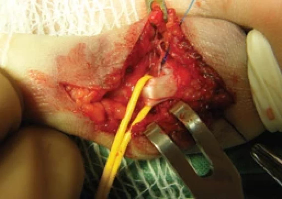 The fragment-to-ligament “around the bone”-like suture completed.