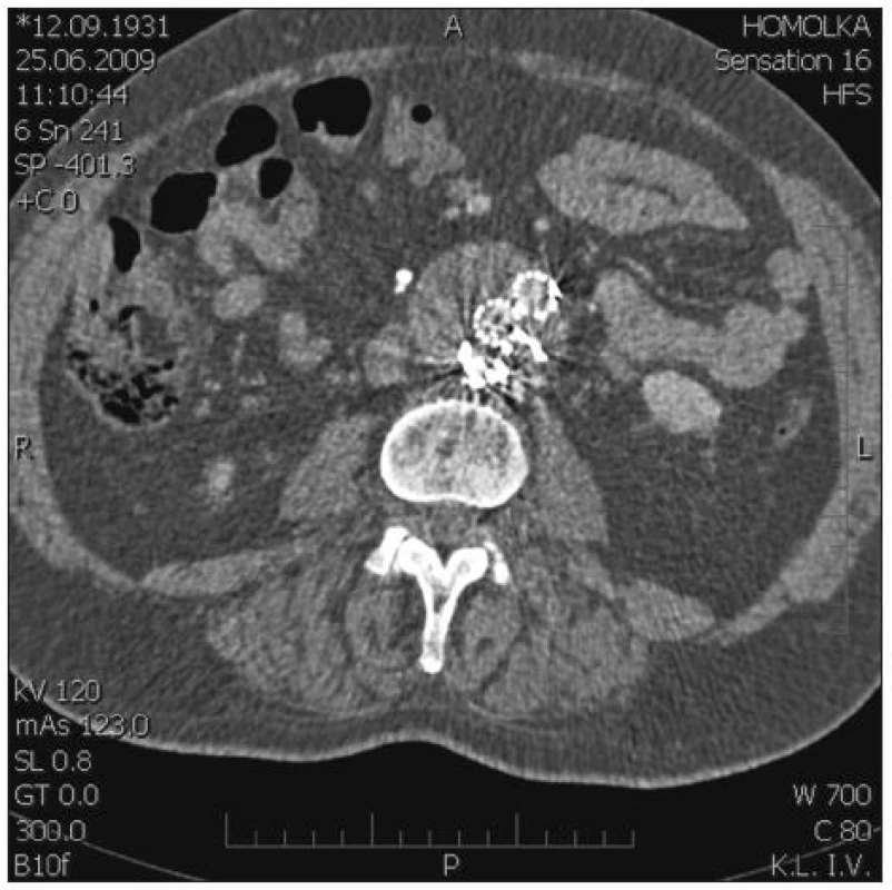 Coily na zadní stěně vaku AAA před ústími aa. lumbales. V přední části vaku dvě raménka SG
Fig. 3. Coils on the posterior AAA sac wall, anterior to the entrances of lumbal arteries. Two SG arms in the anterior part of the sac