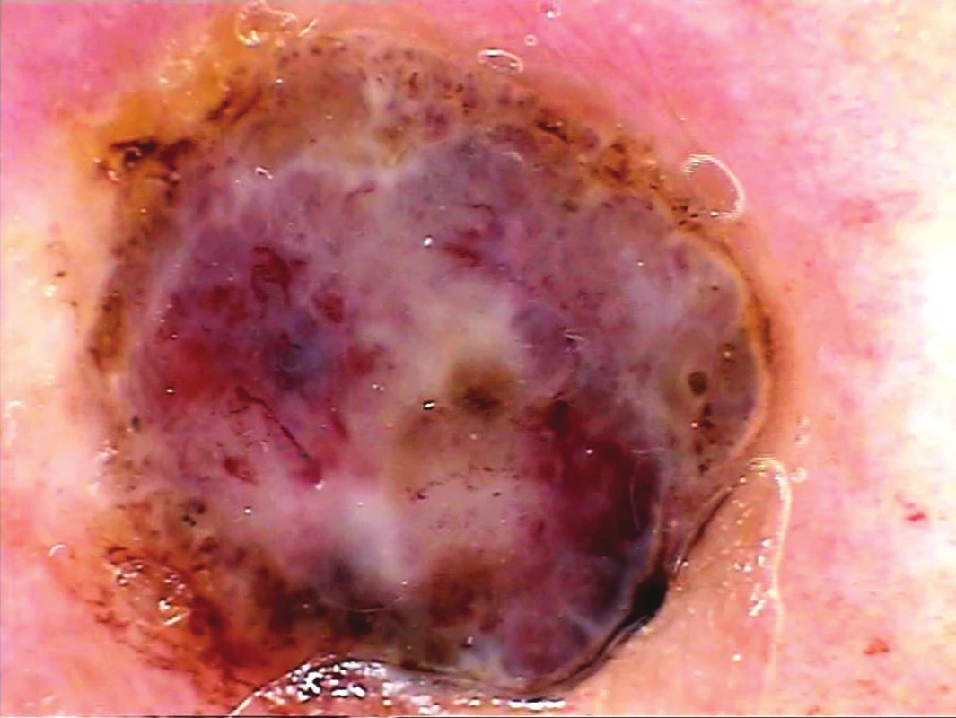 Silný melanom (Breslow 3,0 mm)
Dermatoskopický obraz je polymorfní, chaotický, nepravidelný. Při okraji jsou zbytky hnědé pigmentace podmíněné melaninem, jinak je pozadí většinou růžovočervené s nápadními bělavými liniemi. Cévní struktury jsou výrazně polymorfní a nepravidelně uspořádané, je viditelná ulcerace.