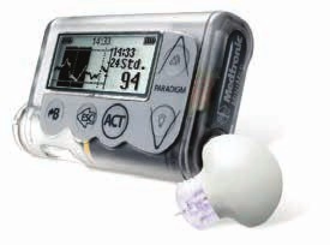 Kombinace inzulínové pumpy a CGM – Minimed Paradigm Veo (Medtronic, USA).