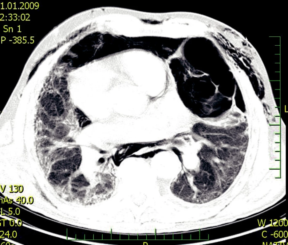 CPFE – forma s oddělenými entitami komplikovaná pneumotoraxem s podkožním emfyzémem (2)