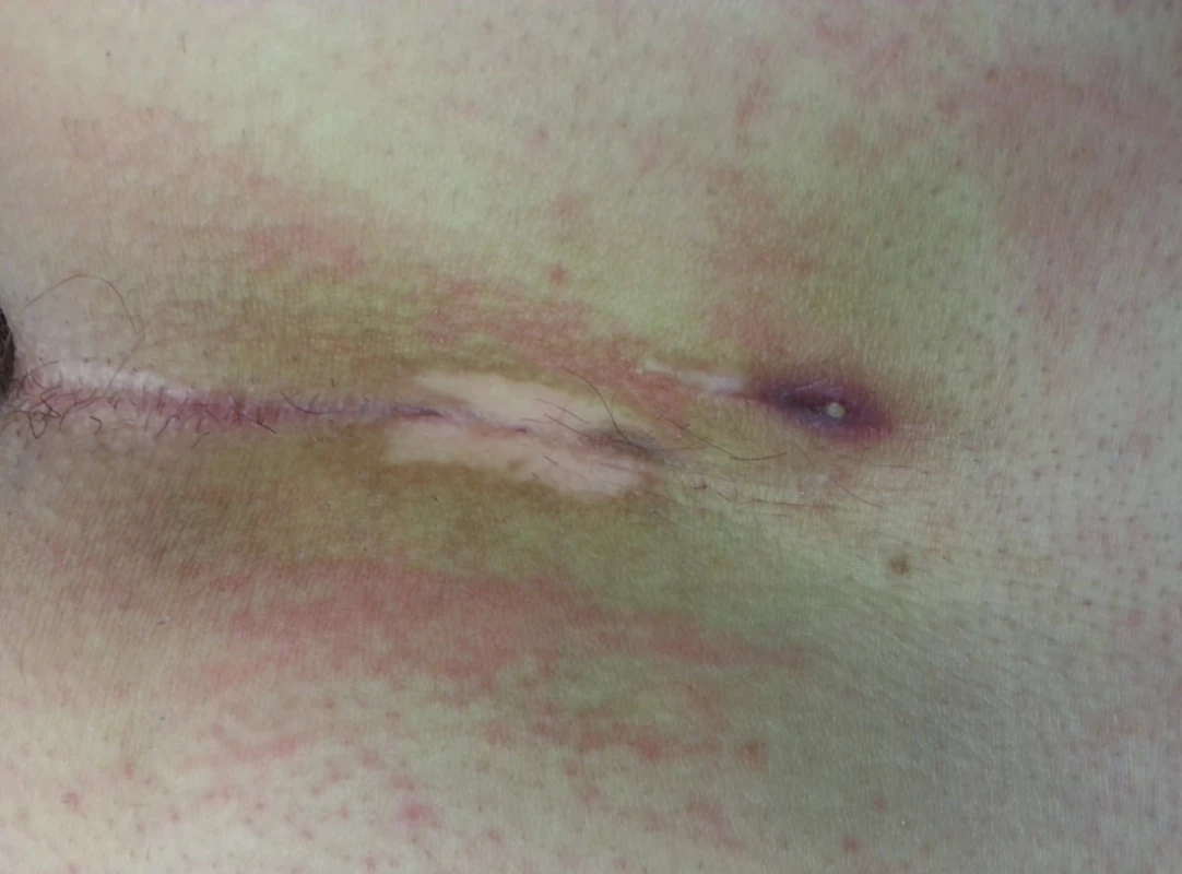 Sinus pilonidalis, chronická faze onemocnění, patrná zevní píštěl
Fig. 1: Pilonidal sinus, chronic phase of the disease, external phistula
