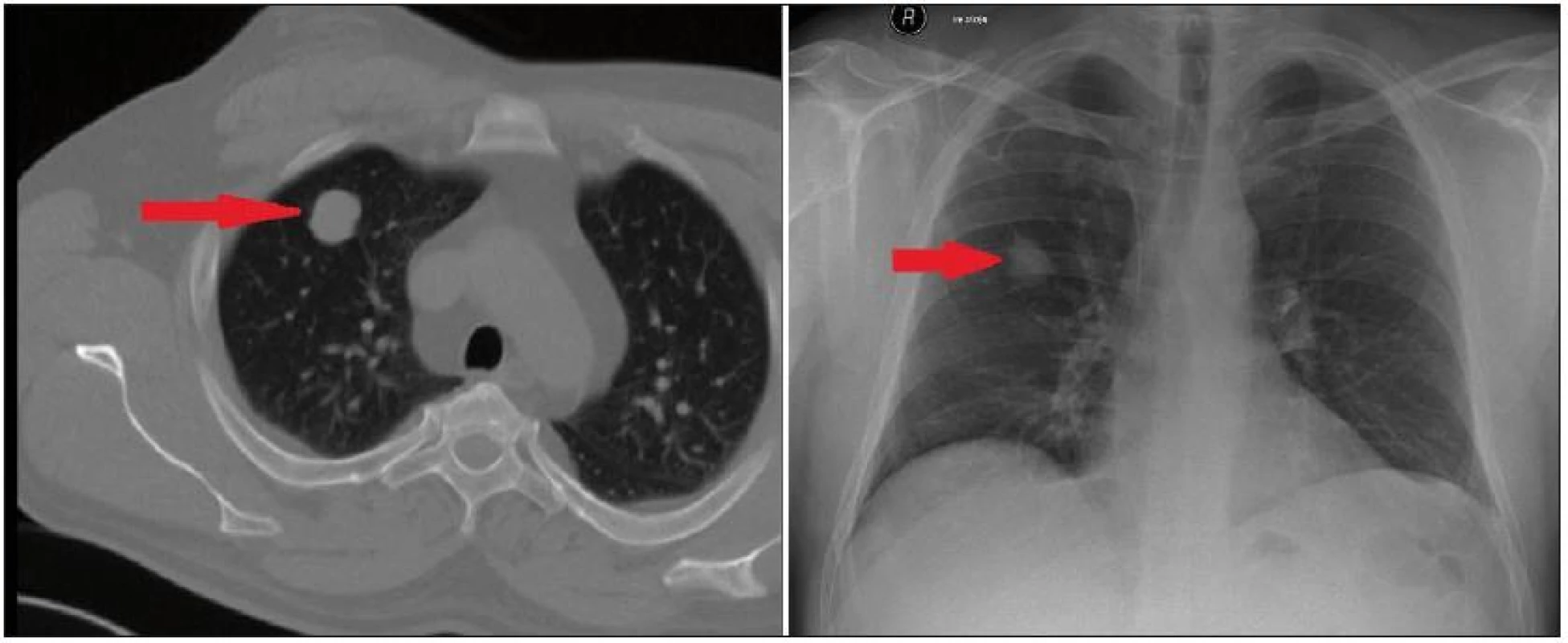 CT a rtg plic s metastázou meningeomu v pravém plicním laloku (označeno šipkou).