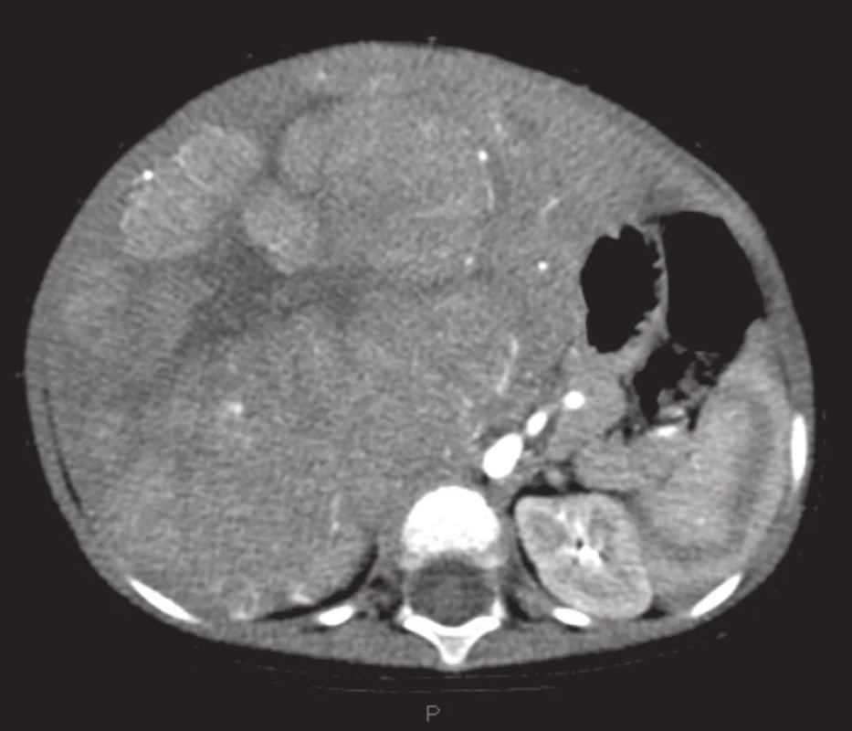 Obrovský hepatoblastóm pravého laloka pečene na CT, pacient č. 3
Fig. 1 Huge hepatoblastoma of liver right lobe on CT, patient No. 3