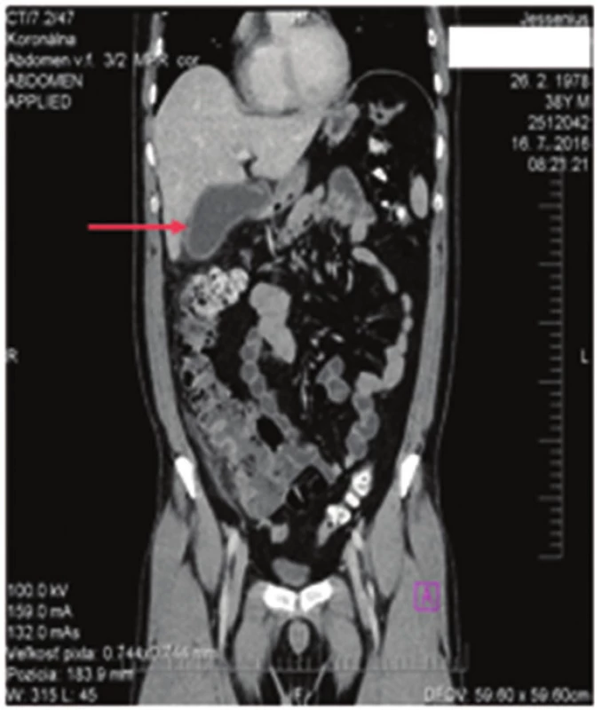 Subakútna cholecystitída
Fig. 2: Subacute cholecystitis