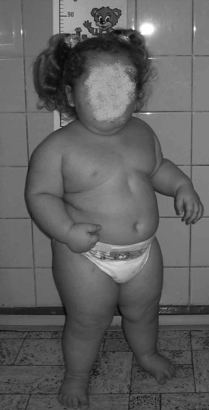 Tříletý pacient se známkami rozvoje metabolického syndromu.
Fig. 1. Three-year patient with signs of metabolic syndrome evolution.