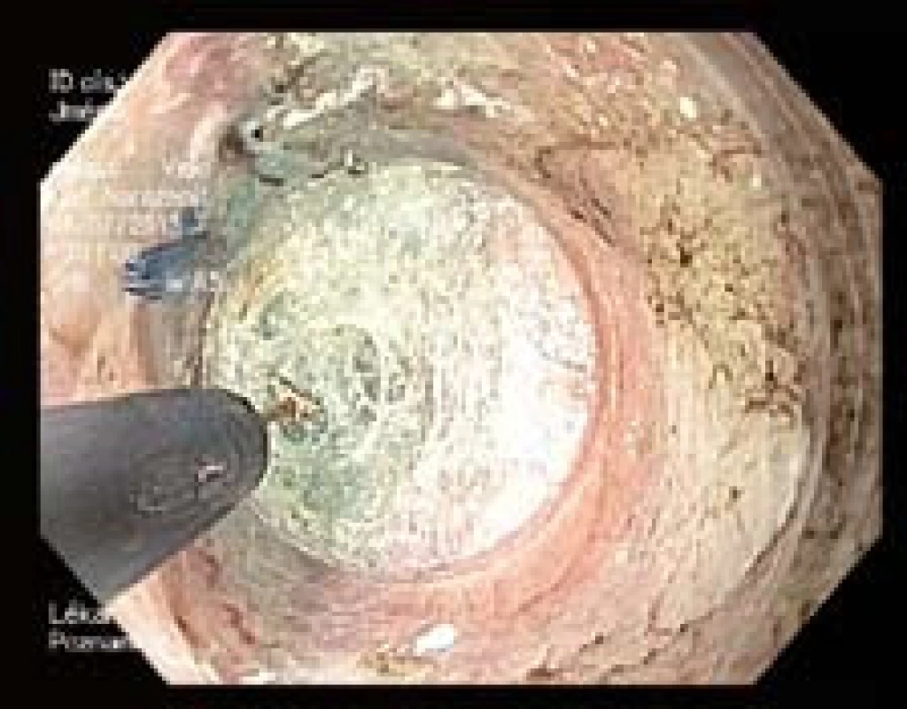 POEM – vytvořený submukózní tunel.
Fig. 4. POEM – submucosal tunnel created.
