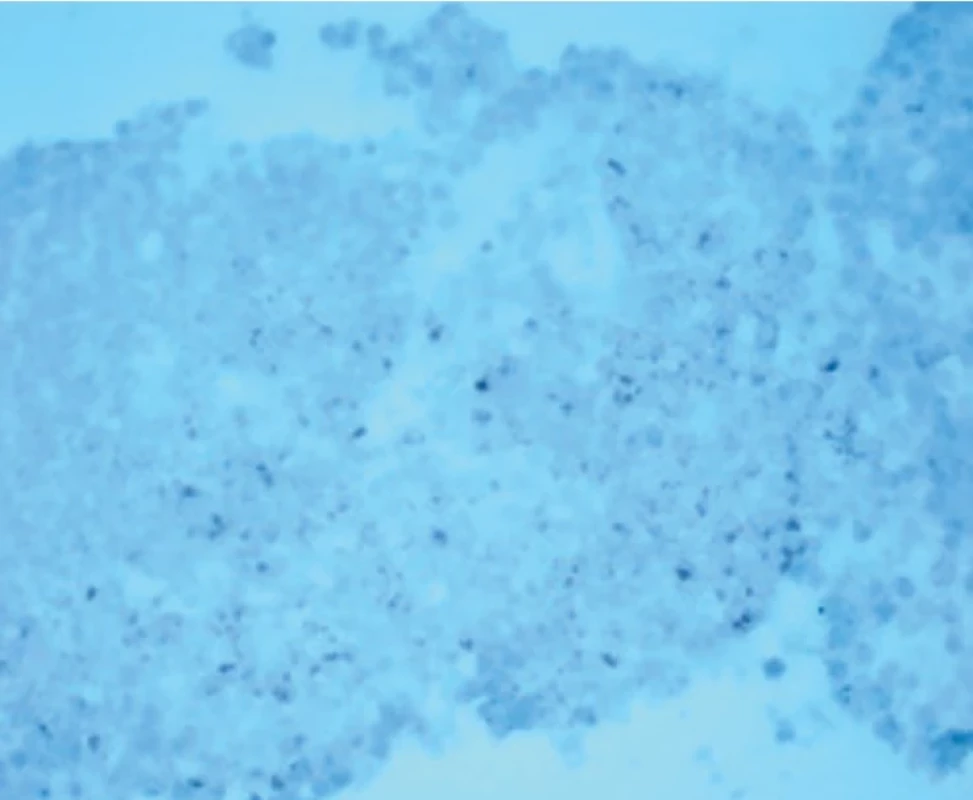  Pozitivní barvení HMB – ložisková pozitivita buněk maligního melanomu. Fig. 5. Positive HMB staining – locus positivity of malignant melanoma cells.