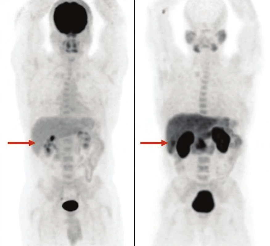 Výnimočne môže byť hepatocelulárny adenóm aj FDG negatívny (A) a FCH pozitívny (B), ako v tomto prípade pacienta so solitárnym hepatocelulárnym adenómom.