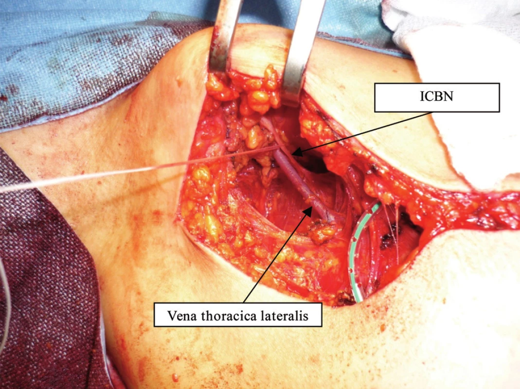 Varianta ICBN – jeden kmen ze 2. mezižebří , křížení s vena thoracica lateralis 
Fig. 2: ICBN variant No.1 – one trunk coming out of 2<sup>nd</sup> intercostal space, crossing vena thoracica lateralis