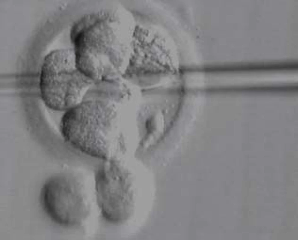 Biopsie blastomery k fixaci na PGD.