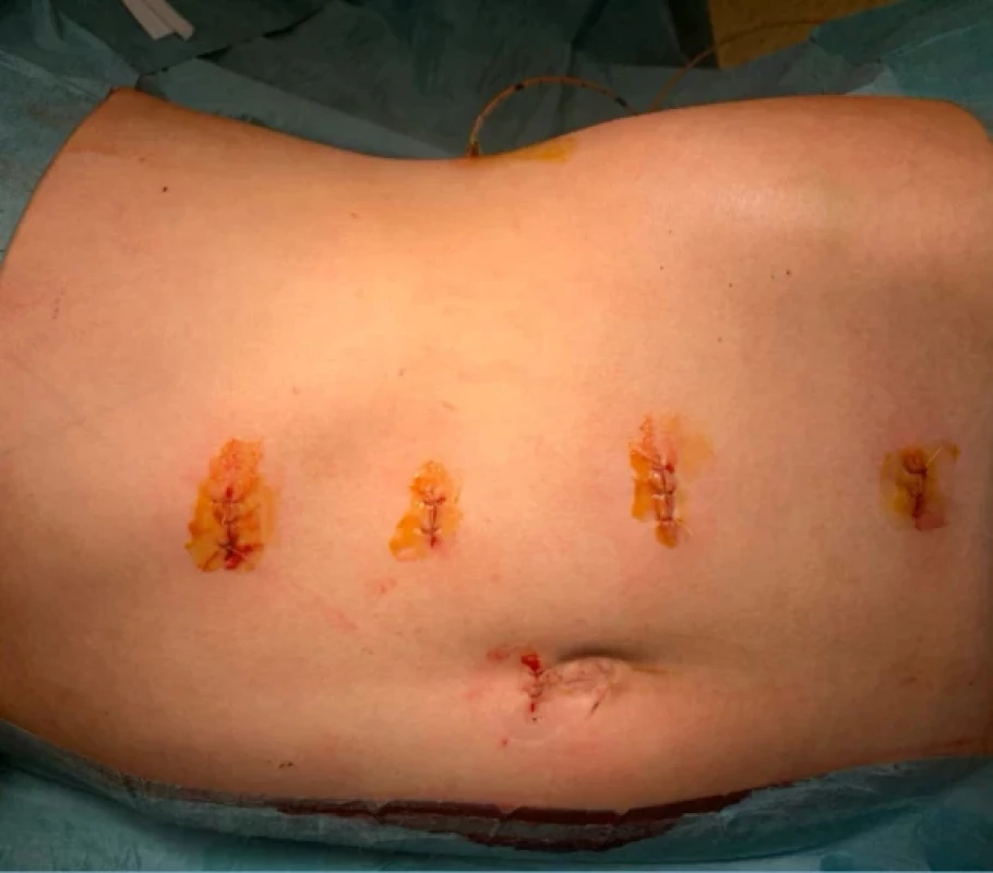 Stejný pacient. Pohled na vyvedenou pyelostomii v přední axilární čáře. Již uzavřené ranky po trokarech. Fig. 4. The same patient. View of the externalized pyelostomy in the anterior axillary line. Trocar incision sites after closure. 