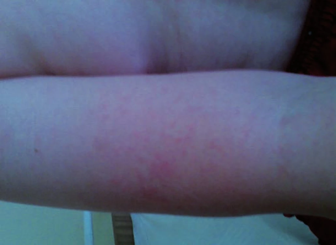 Erythema infectiosum: exantém na horní končetině u pacienta č. 2.
Fig. 2. Erythema infectiosum: rash on the upper extremity in patient No. 2.