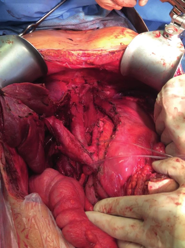Před a po resekci tumoru
Fig. 3: Before and after the resection of the tumor
