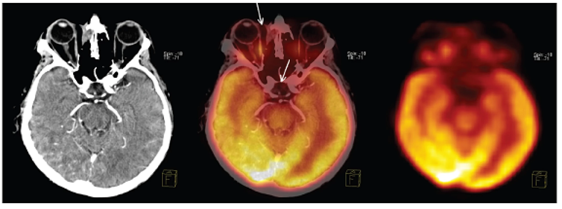 <sup>18</sup>F-FDG PET/CT po 2 cyklech imunochemoterapie lymfomu a po exstirpaci adenomu hypofýzy. Nepřítomnost zvýšené akumulace <sup>18</sup>F-FDG v reziduální tkáni v pravé očnici i v oblasti hypofýzy (šipky) – bez známek přítomnosti viabilní nádorové tkáně v obou lokalizacích. Tomografické řezy proložené rovinou procházející reziduální tkání v pravé orbitě a hypofýzou. Zleva CT, fúze PET/CT, PET.