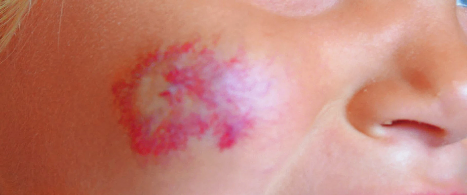 Reziduum neléčeného hemangiomu.
Fig. 2. Residue of untreated hemangioma.
