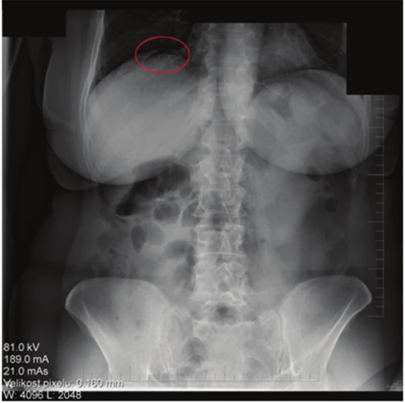 Skiaskopický snímek břicha – volný vzduch v podbráničním prostoru
Fig. 4: Skiascopy – subdiaphragmatic free air