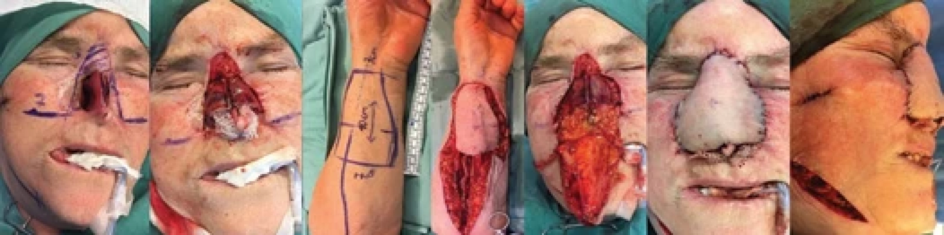 First stage of nasal reconstruction with Chinese fl aps suitable for combined defects of the lining and columella. (Source: author's photo archive).