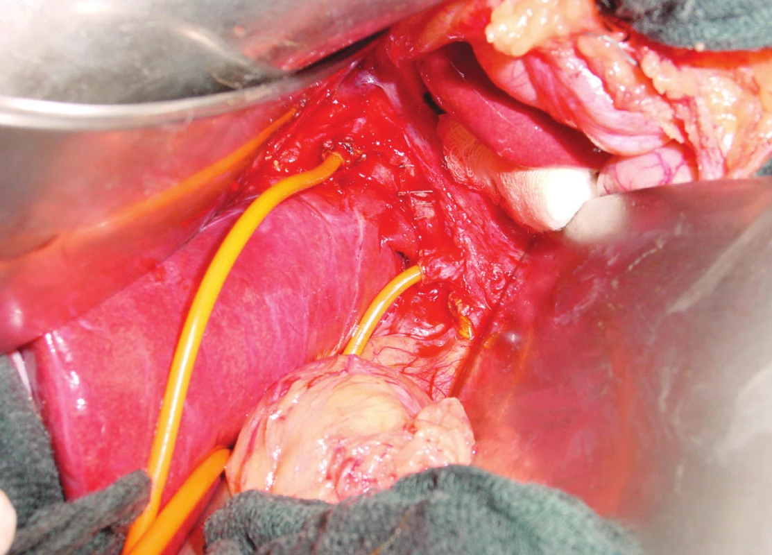 Peroperační situace ztrátového poranění žlučových cest s vytětím choledochu
Fig. 3. Bile duct injury with bile duct removal, peroperative condition