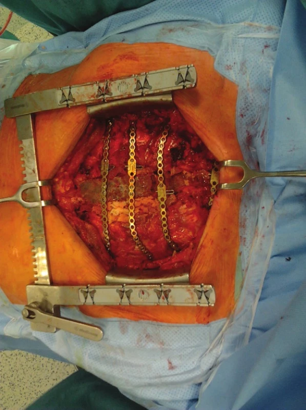 Rekonstrukce hrudní stěny kostním štěpem sterna a drcenou kostní spongiózou
Fig. 2: Reconstruction of the chest wall using the sternal bone graft and crushed spongy bone