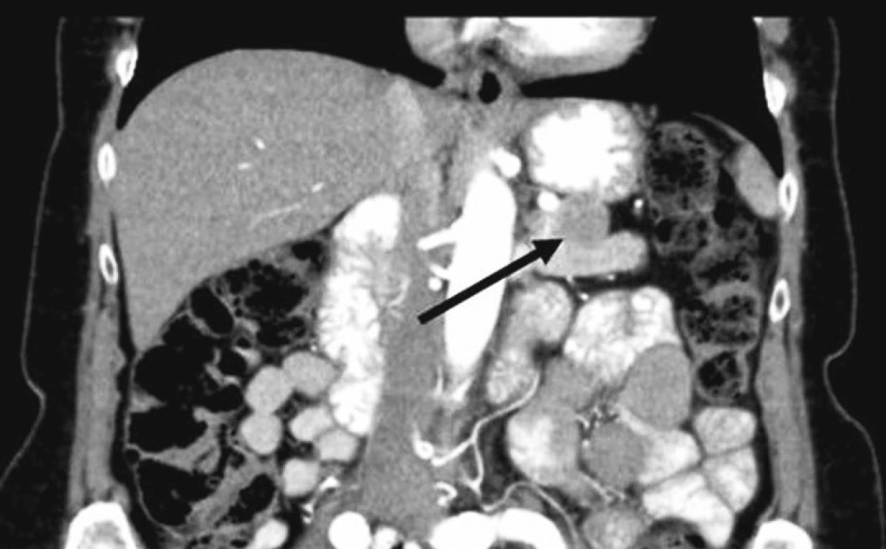 Na zadnú stenu žalúdka naliehajúci tumor prednej plochy pankreasu
Fig. 1. Anterior pancreatic tumor touching the posterior gastric wall
