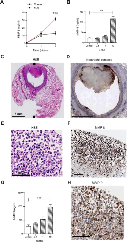 Neutrophil MMP-8 and -9 are upregulated in human TB.