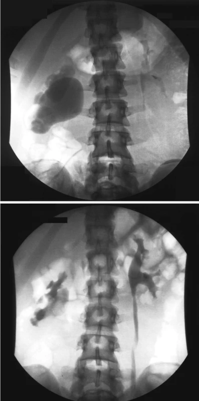 a, b. Výsledek resekční plastiky podle Andersona-Hynese
Fig. 4 a, b. Outcomes of the resection, Anderson-Hynes plasty