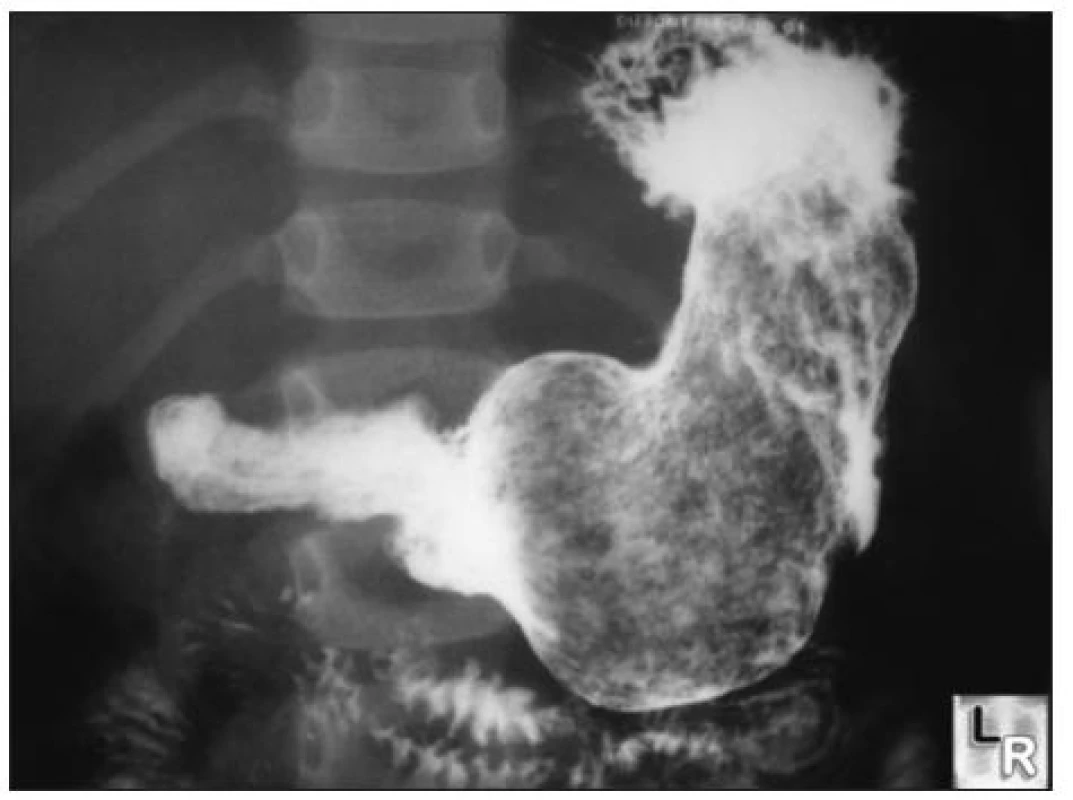 RTG s kontrastem – Zdroj [4]
Fig. 2. Contrast x- ray – Source [4]