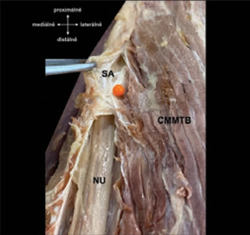 Nervus ulnaris krytý distálním koncem Struthersovy  arkády (oranžová značka).  Fig. 2. Nervus ulnaris covered by the distal end of Struthers’  arcade (marked in orange).