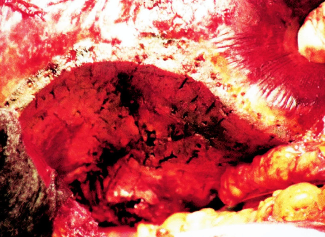 Vzhled resekčního okraje po ukončení jaterní resekce
Fig. 6. The resection edge after completion of the liver resection procedure 