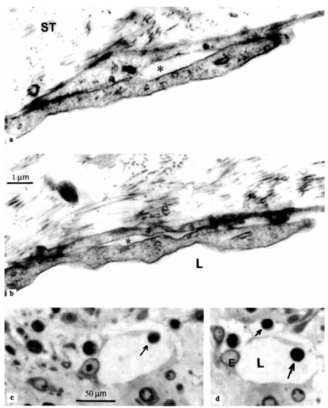 Elektrónovo-mikroskopické obrázky a mikrofotografie endotelových mikrochlopní lymfatických kapilár synoviálnej membrány od pacientky s juvenilnou idiopatickou artritídou.
a, b – ultraštruktúra špecializovaných medzibunkových spojení – endotelových mikrochlopní. Sú vytvorené prekrývajúcimi sa výbežkami susedných endotelových buniek. Vlákna z okolitého spojivového tkaniva (ST) sú zakotvené do vonkajšieho výbežku. Malé medzery (hviezdičky) sú zobrazené medzi vnútorným a vonkajším cípom. Ultratenké rezy kontrastované uranylacetátom a citranom olovnatým;
c, d – lymfocyt (šípka), ktorý vstúpil do lúmena lymfatickej kapiláry (L) cez otvorenú endotelovú mikrochlopňu. Ďalší lymfocyt (malá šípka) sa nachádza v prelymfatickom tkanivovom kanáliku – na jeho ceste z interstícia do lúmena lymfatickej kapiláry. Polotenké rezy farbené toluidínovou modrou.