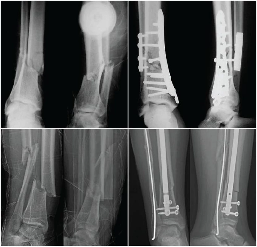 Podobné typy zlomenin s osteosyntézou dlahou a hřebem