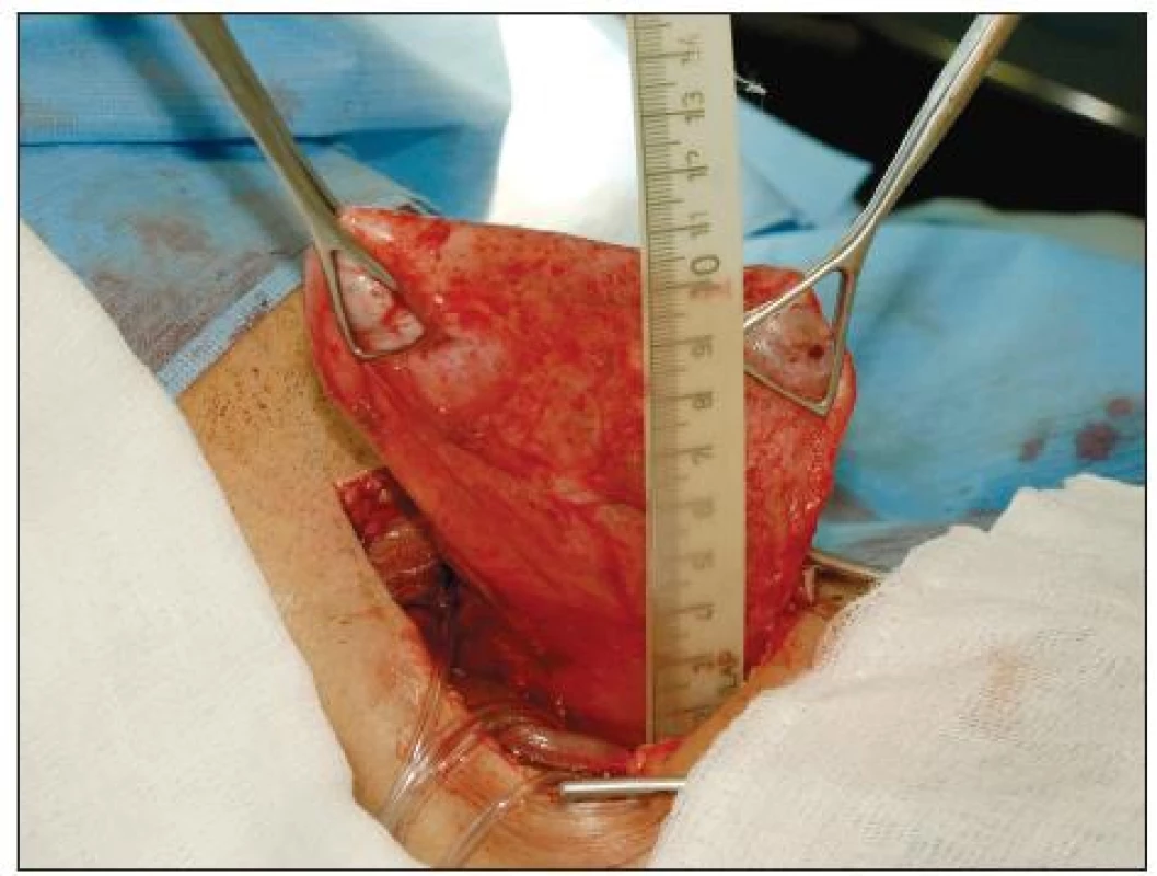 Peroperační snímek
Pic. 2. Intraoperative photo