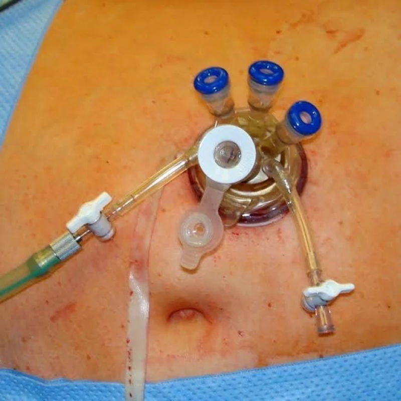 TriPort™ (Olympus)
Fig. 3. TriPort™ (Olympus)