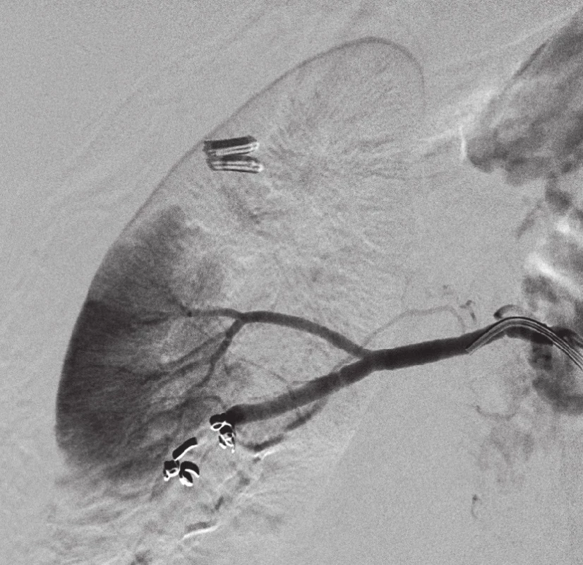 Selektivní embolizace dolní pólové větve pomocí spirál, větev pro pars intermedia je zachovaná
Fig. 3. Selective embolization of the lower pole branch with the use of coils, the branch for pars intermedia is preserved