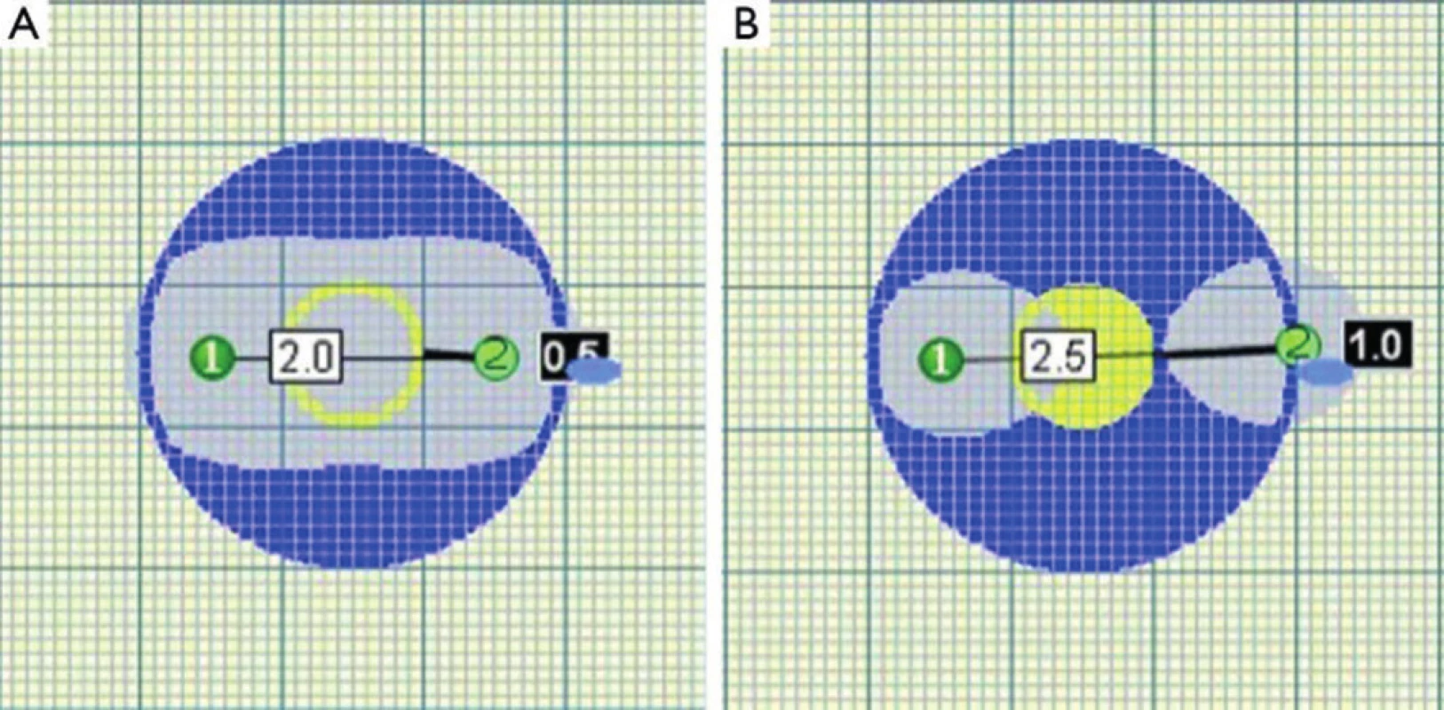 Překročení kritické vzdálenosti elektrod vede k porušení homogenity zóny ablace
Fig. 3. Homogenity of ablated area is impaired when critical distance of probes is exceeded